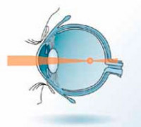 Auge Kurzsichtigkeit Lasern lassen